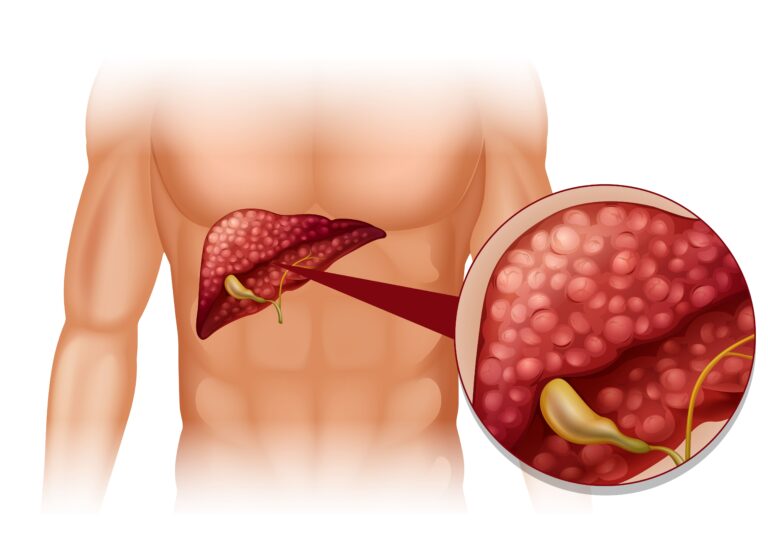 Cirrhosis (2)