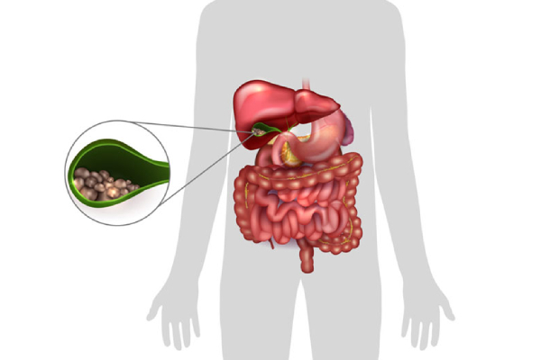 gall-stones